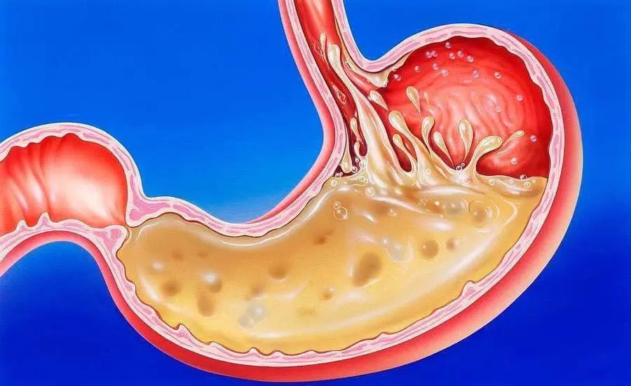 Uống Nước iON Kiềm Kangen Thì Có Bị Trung Hòa Axit Dạ Dày... Nếu Tôi Uống Nước Kiềm Thì Có Bị Trung Hòa Axit Dạ Dày Không?